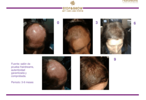 alopecia fermin peluqueros